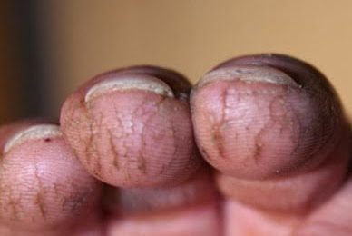 cracked fingertips winter tip dry healing preventing painfully steps prevention outside always cover when cure